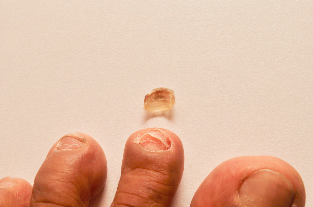 Décollement de l'ongle, infection, mycose