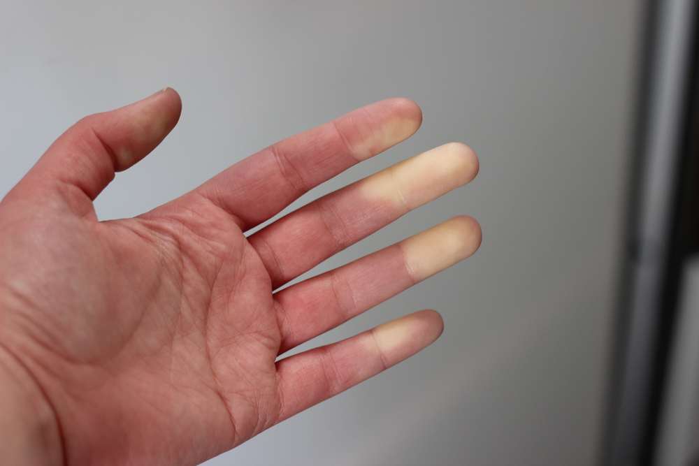 Le phénomène de Raynaud