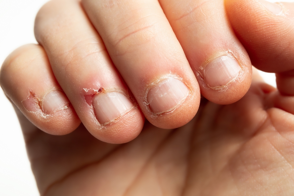 Onychophagie : comment arrêter de se ronger les ongles