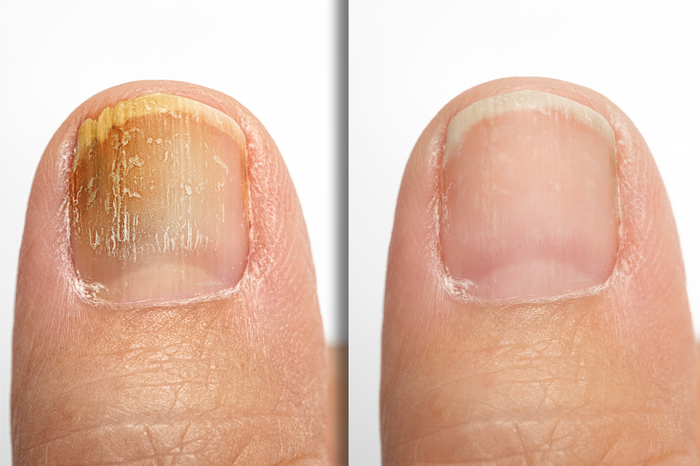 Pourquoi les ongles ont tendance à devenir jaunes