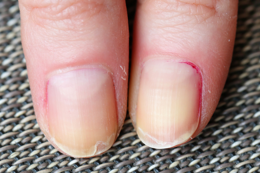 Pourquoi nos ongles se dédoublent-ils?