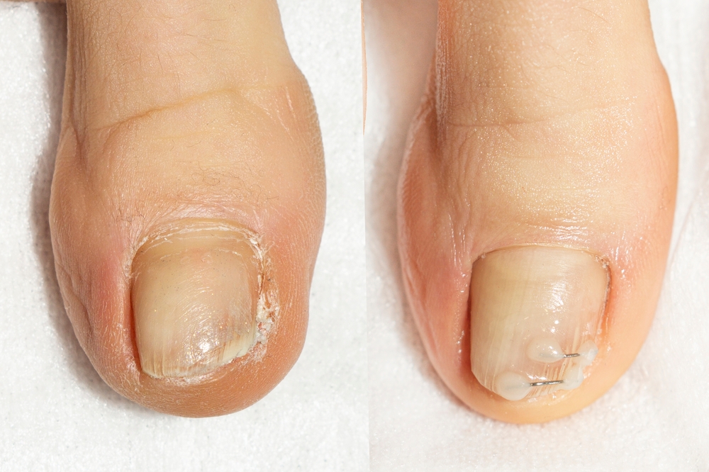 Quelles sont les principales maladies déformantes des ongles